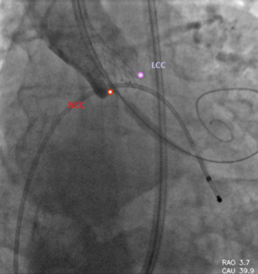 aortic-cusps-1