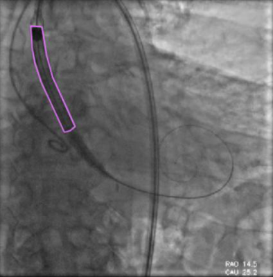 catheter-polygon